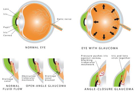 Diagnostic and Procedural Codes for Glaucoma and Glaucoma。